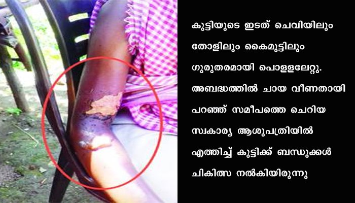 തിളച്ച ചായ മകളുടെ ദേഹത്തൊഴിച്ച് പൊളളിച്ചതായി പരാതി