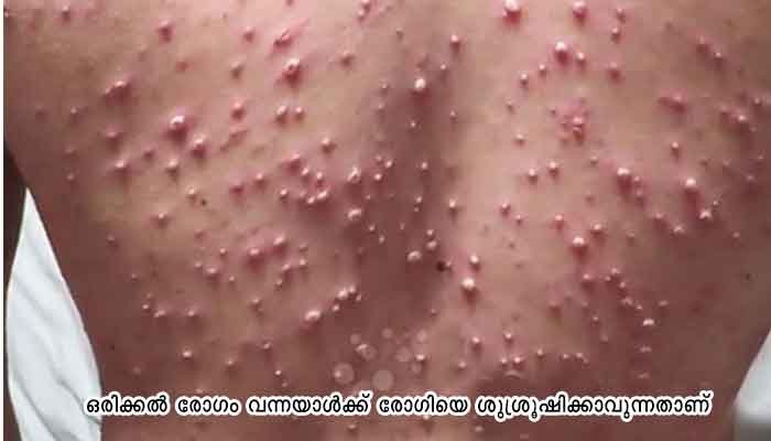 ചിക്കൻപോക്‌സിനെതിരെ ജാഗ്രത വേണം