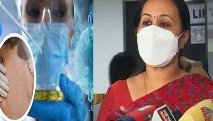 മങ്കിപോക്സ്: പ്രതിരോധ പ്രവർത്തനങ്ങൾ ഊർജിതമാക്കി: മന്ത്രി വീണാ ജോർജ്